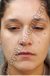 Nose Woman White Birthmarks Average